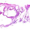 1B1 Anencephaly (Case 1) 1A H&E whole mount