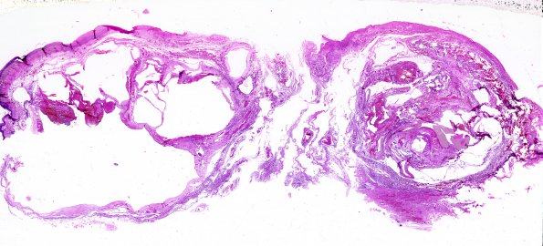 1B1 Anencephaly (Case 1) 1A H&E whole mount