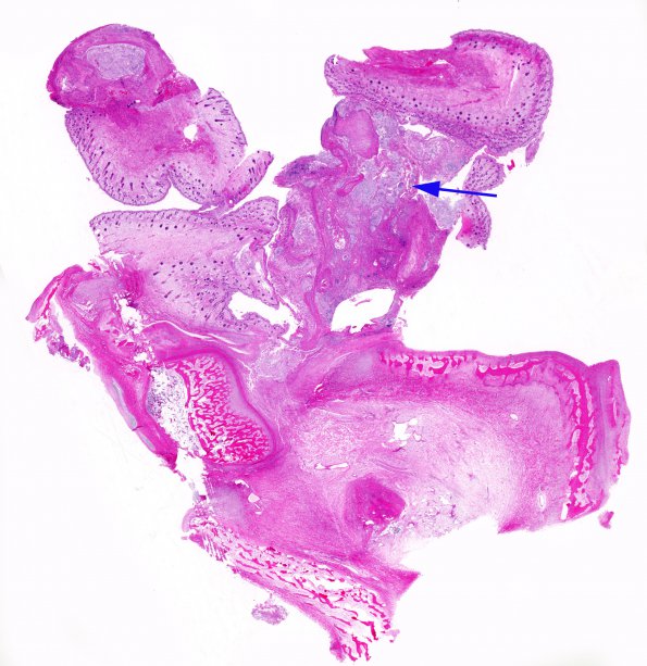 3A1 Anencephaly (Case 3) H&E whole mount