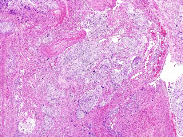 3A2 Anencephaly (Case 3) H&E 2A