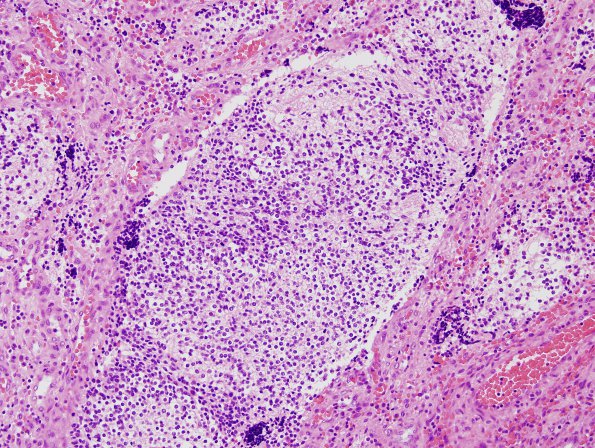 3A3 Anencephaly (Case 3) H&E 1