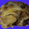 5 Anencephaly (Case 6) 3