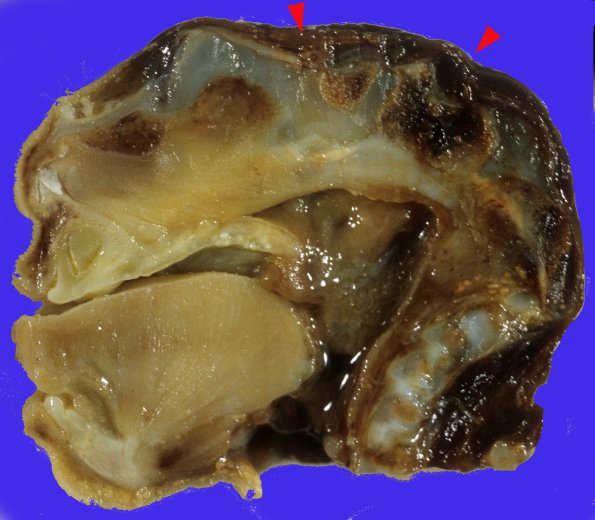 5 Anencephaly (Case 6) 3