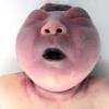 6A1 Exencephaly-Anencephaly (Case 6)_1