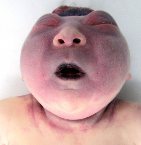 6A1 Exencephaly-Anencephaly (Case 6)_1