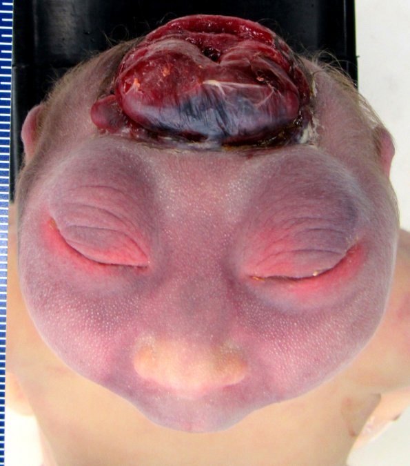 6A3 Exencephaly-Anencephaly (Case 6)_4