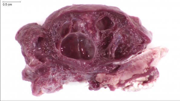 6B1 Exencephaly-Anencephaly (Case 6)_17