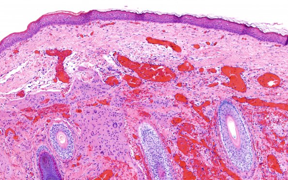 6C1 Exencephaly-Anencephaly (Case 6) N1 H&E 10X