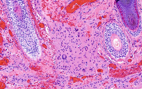 6C2 Exencephaly-Anencephaly (Case 6) N1 H&E 20X