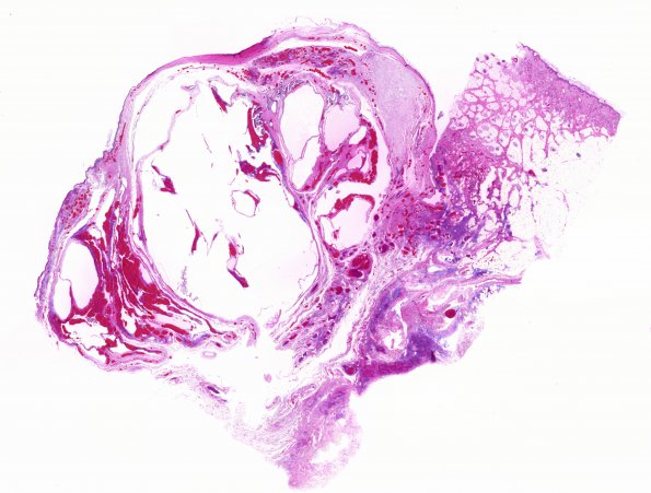 6C3 Exencephaly-Anencephaly (Case 6) N2 H&E whole mount