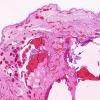 6C4 Exencephaly-Anencephaly (Case 6) N4 H&E 2X copy