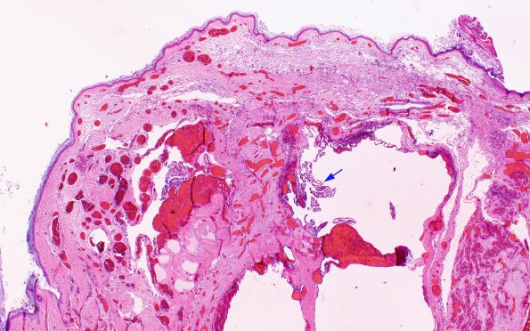 6C4 Exencephaly-Anencephaly (Case 6) N4 H&E 2X copy