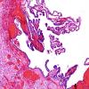 6C5 Exencephaly-Anencephaly (Case 6) N4 H&E 20X