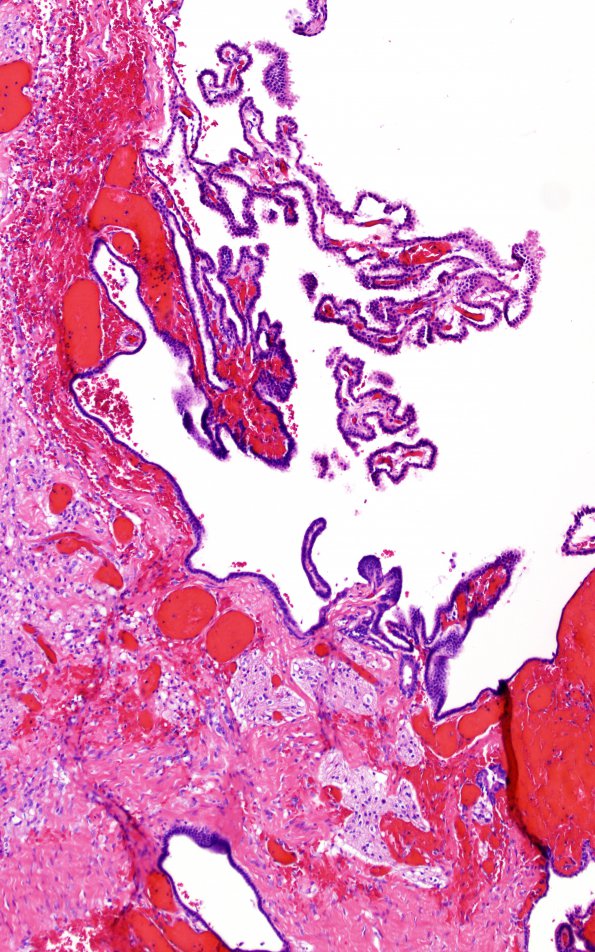 6C5 Exencephaly-Anencephaly (Case 6) N4 H&E 20X