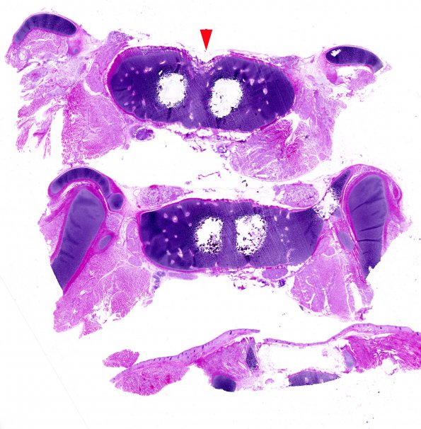 7B Craniorachischisis totalis, conjoint twins (Case 9) H&E whole mount spine