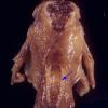 8 Anencephaly with lumbosacral rachischisis (Case 7) 1