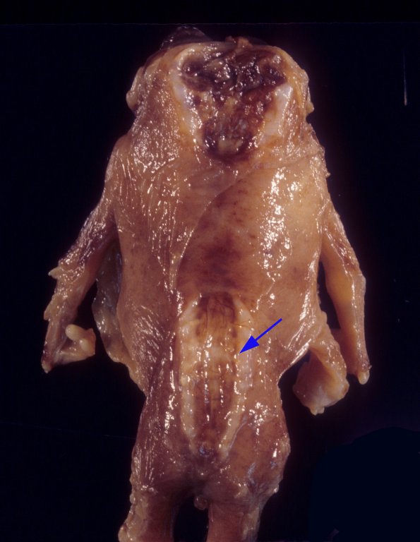 8 Anencephaly with lumbosacral rachischisis (Case 7) 1