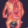 Anencephaly