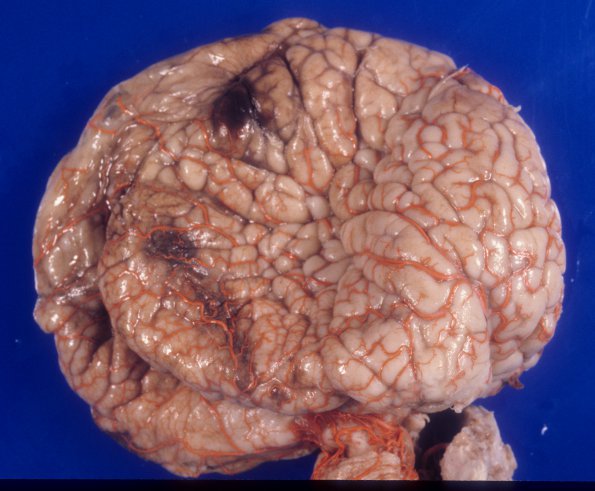 10A1 Hydrocephalus, aqueductal stenosis (Case 10) 1