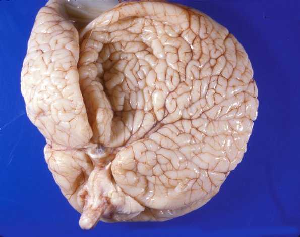 11A1 Aqueductal Stenosis with Hydrocephalus (Case 11) a