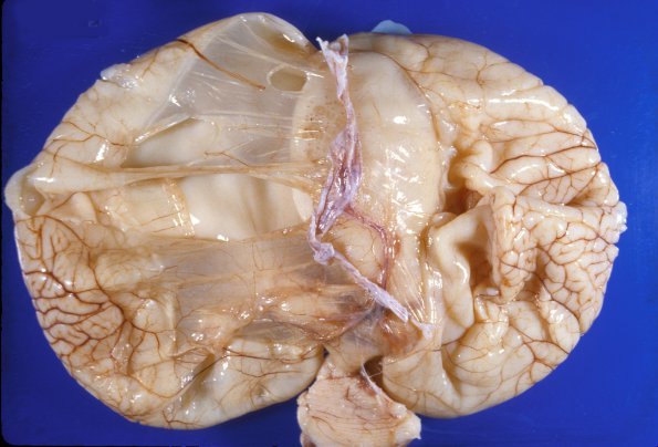 11A2 acqueductal stenosis 5A Hydrocephalus (Case 11) 1A