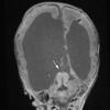 12A2 Aqueductal stenosis (A18-280) T1 MPRAGE 2 - Copy copy