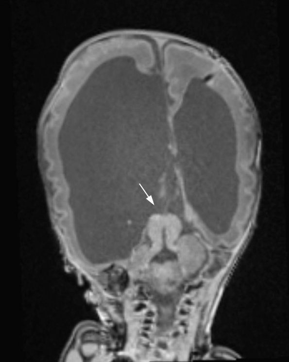 12A2 Aqueductal stenosis (A18-280) T1 MPRAGE 2 - Copy copy