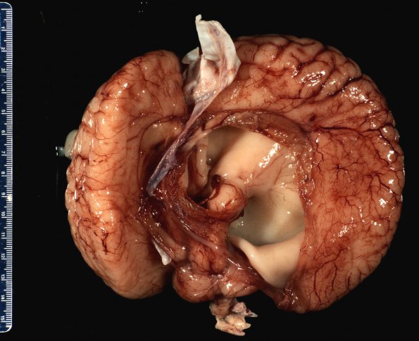 12C2 Aqueductal stenosis (Case 12) _4