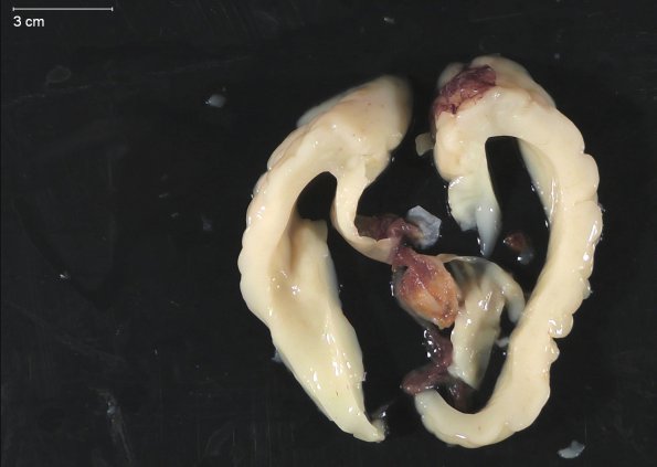 12C4 Aqueductal stenosis (Case 12) _6