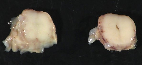 12C5 Aqueductal stenosis (Case 12) _7