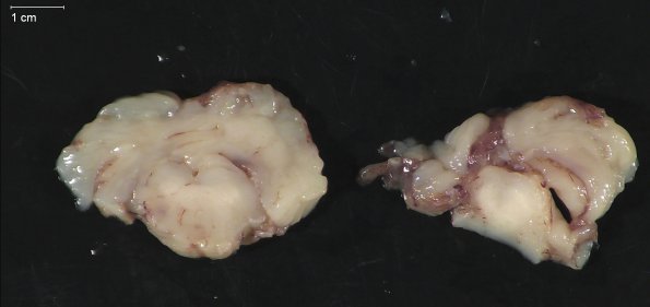 12C6 Aqueductal stenosis (Case 12) _9