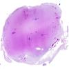 12D1 Aqueductal stenosis (Case 12) N6 H&E WM copy