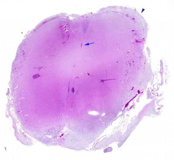 12D1 Aqueductal stenosis (Case 12) N6 H&E WM copy