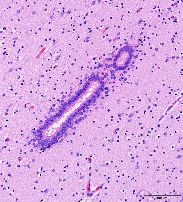 12D2 Aqueductal stenosis (Case 12) N6 H&E WM copy