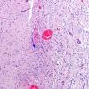 12D4 Aqueductal stenosis (Case 12) N6 H&E 10X 2 copy