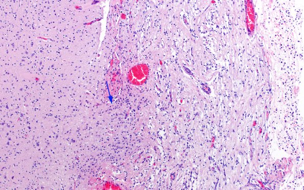 12D4 Aqueductal stenosis (Case 12) N6 H&E 10X 2 copy