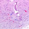 12D5 Aqueductal stenosis (Case 12) N6 H&E 10X copy