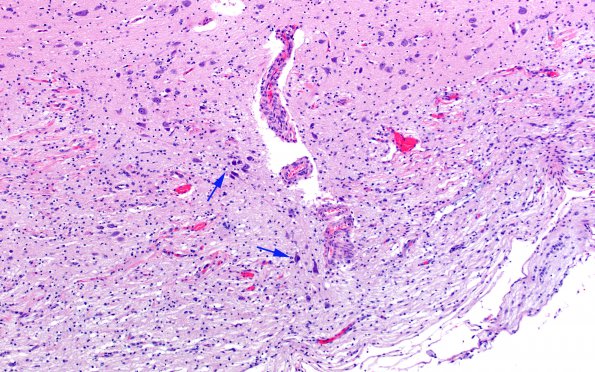 12D5 Aqueductal stenosis (Case 12) N6 H&E 10X copy