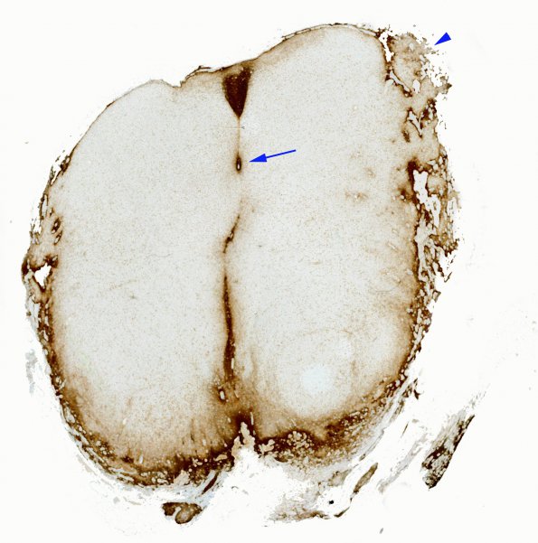 12E1 Aqueductal stenosis (Case 12) N6 GFAP WM copy copy