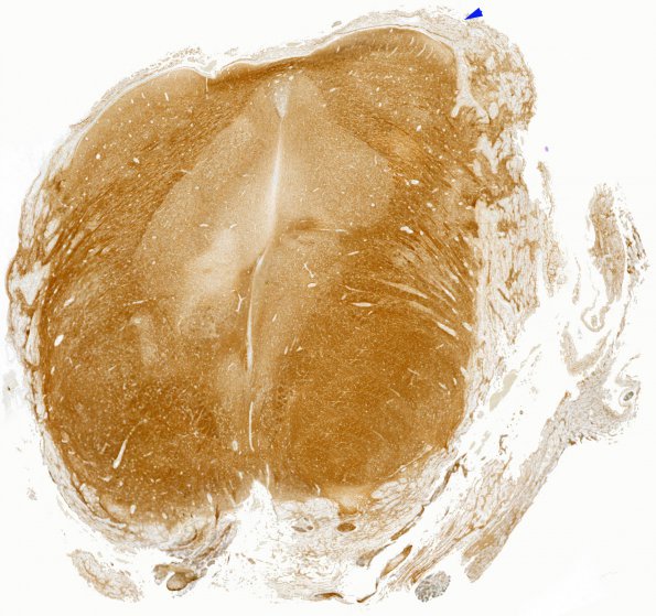 12E6 Aqueductal stenosis (Case 12) N6 NF WM copy