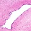 1B2 Aqueductal stenosis (Case 1) H&E whole mount