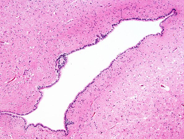 1B2 Aqueductal stenosis (Case 1) H&E whole mount