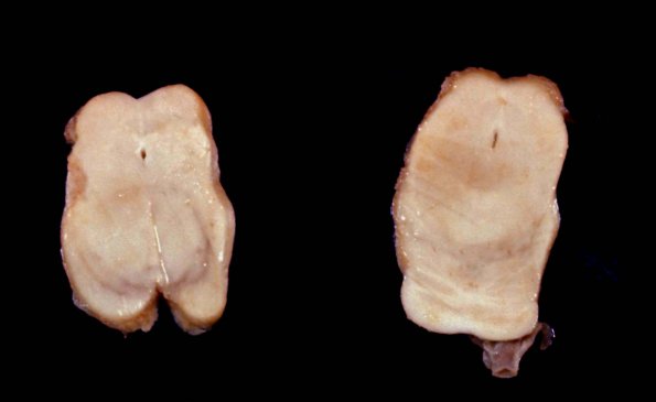 2A1 Aqueductal Stenosis 2 (Case 2)