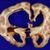 2A3 Aqueductal Stenosis 1b (Case 2)