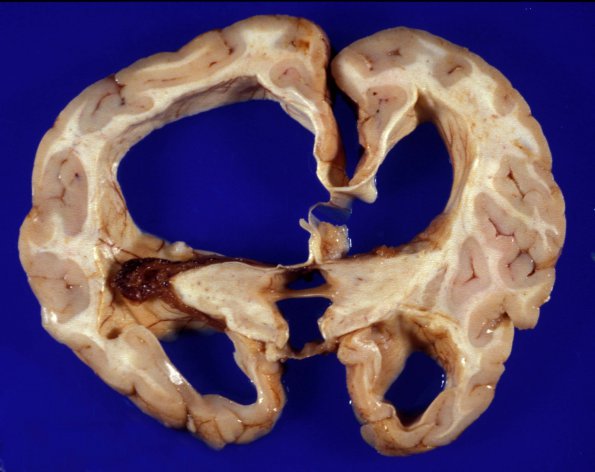 2A3 Aqueductal Stenosis 1b (Case 2)