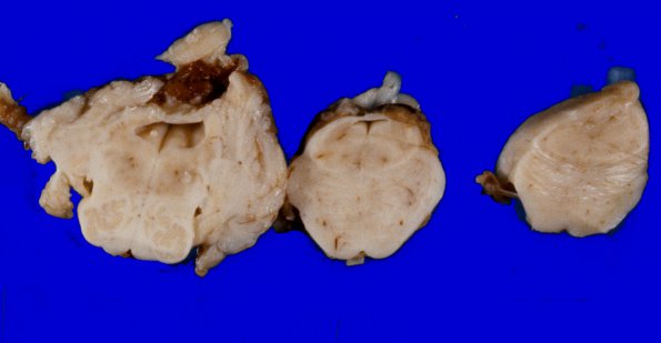 3A1 Aqueductal Stenosis (Case 3) gross 1