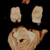 4 Aqueductal Stenosis (Case 4)