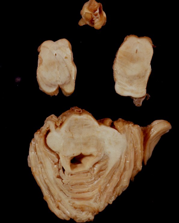 4 Aqueductal Stenosis (Case 4)