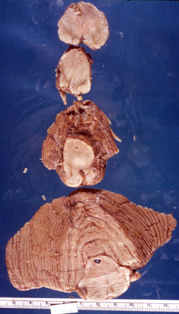 5 Aqueductal Stenosis (Case 5)