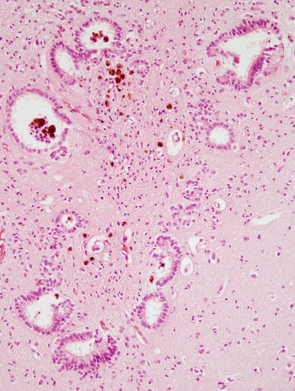 6A3 Aqueductal Gliosis (Case 6) 2 hemorrhage